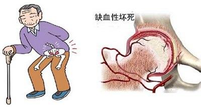 股骨头坏死